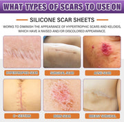 Silicone Scar Sheets