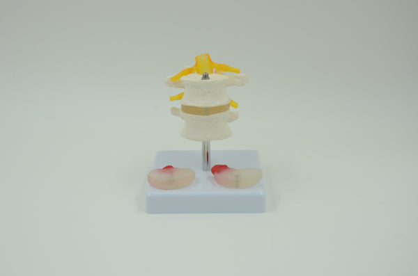 2 LUMBAR VERTEBRA WITH HERNIA AND PROLAPED INVERTEBRAL DISC