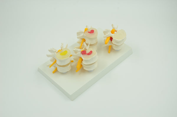 4-STAGES DISEASED VERTEBRA MODEL