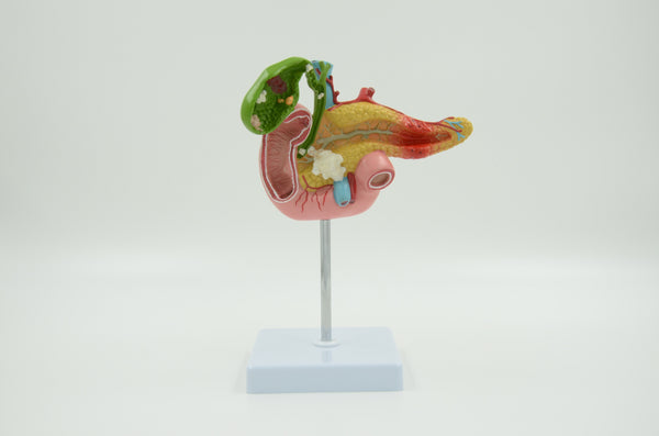 PATHOLOGICAL MODEL OF THE PANCREAS ,DUODENUM AND GALLBLADDER