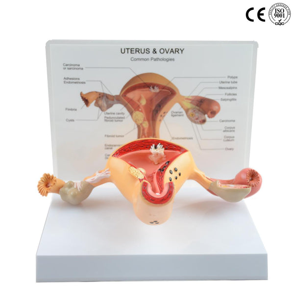 DISEASED UTERUS/UTERUS-OVARY MODEL